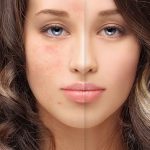 Cum poti avea grija de un ten acneic